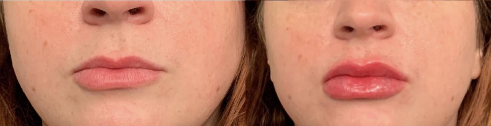 Before and After Image: Case #72 - front