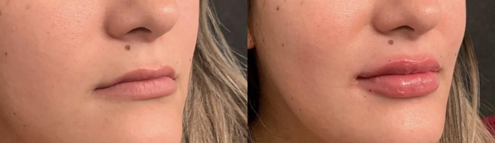 Before and After Image: Case #74 - right-front-oblique