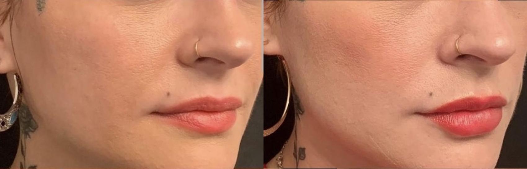 Before and After Image: Case #76 - right-front-oblique