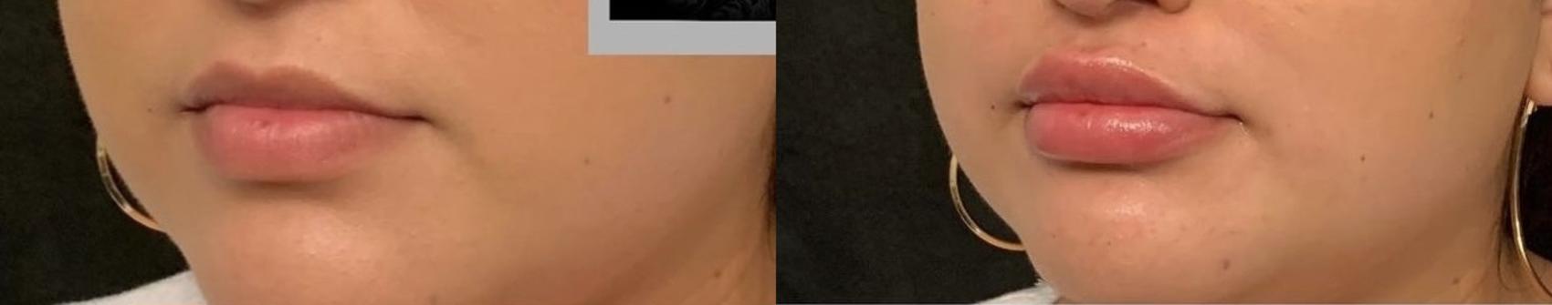 Before and After Image: Case #77 - left-front-oblique