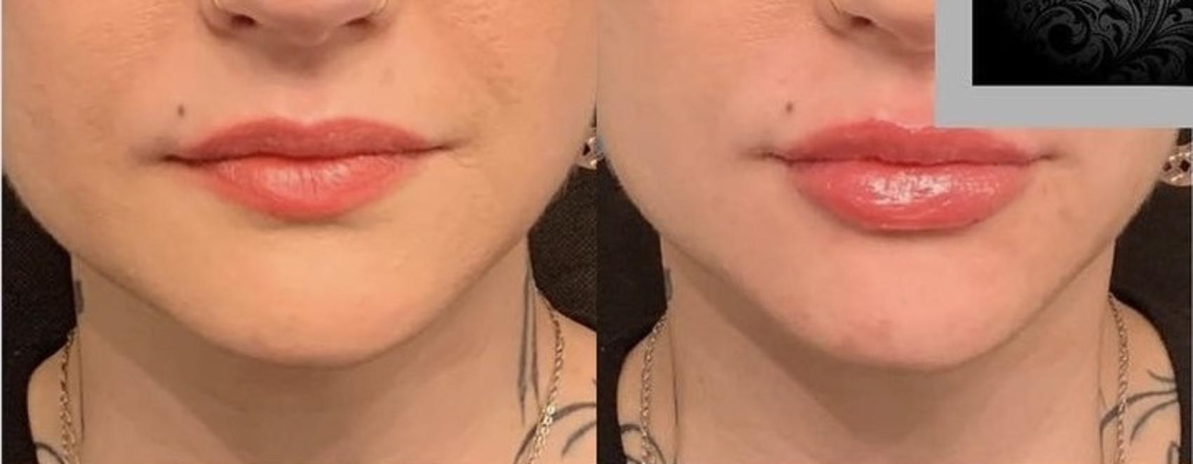 Before and After Image: Case #78 - front