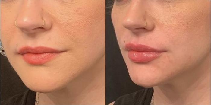 Before and After Image: Case #78 - left-front-oblique