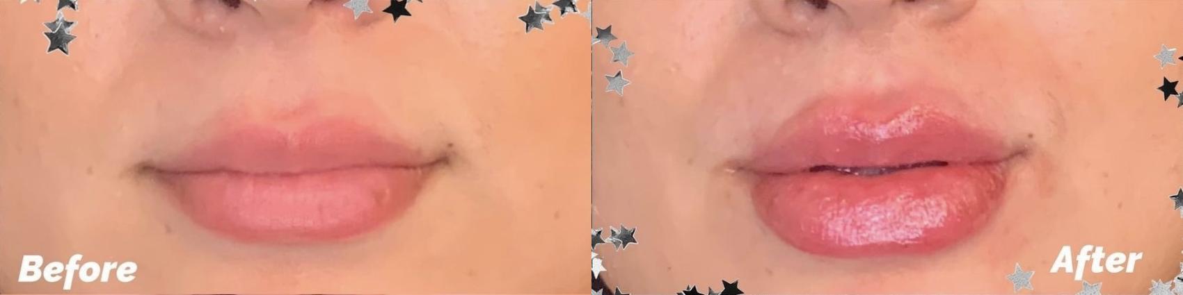 Before and After Image: Case #79 - front