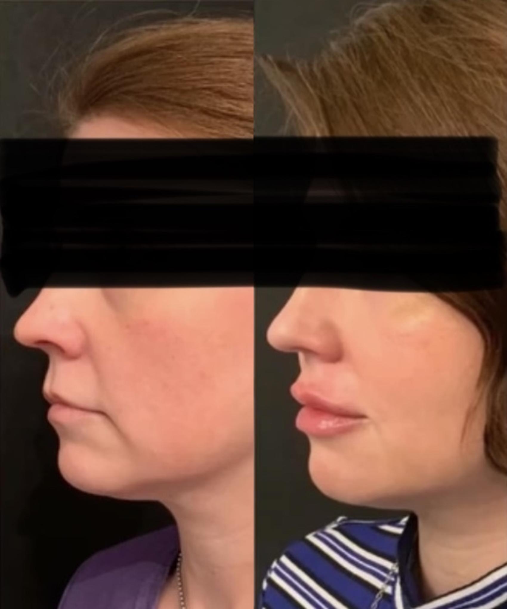 Before and After Image: Case #82 - left-side