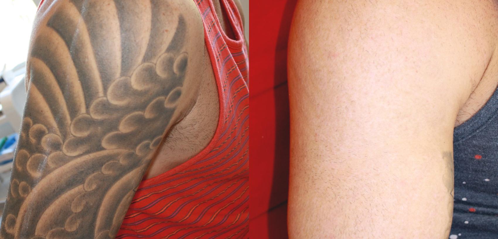 Before and After Image: Case #9 - right-side