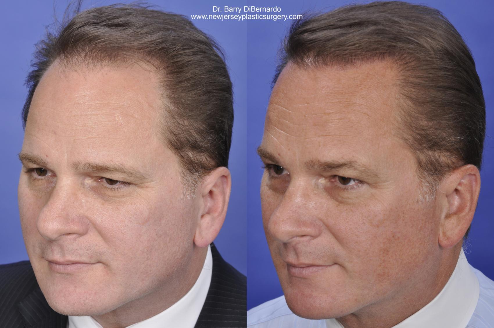 Before and After Image: Case #39 - left-front-oblique