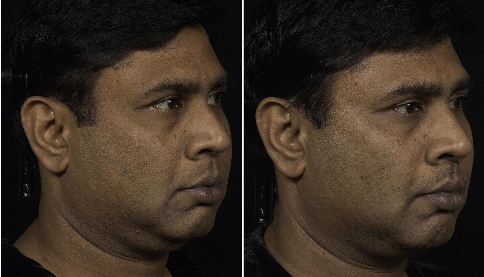 Before and After Image: Case #33 - right-front-oblique