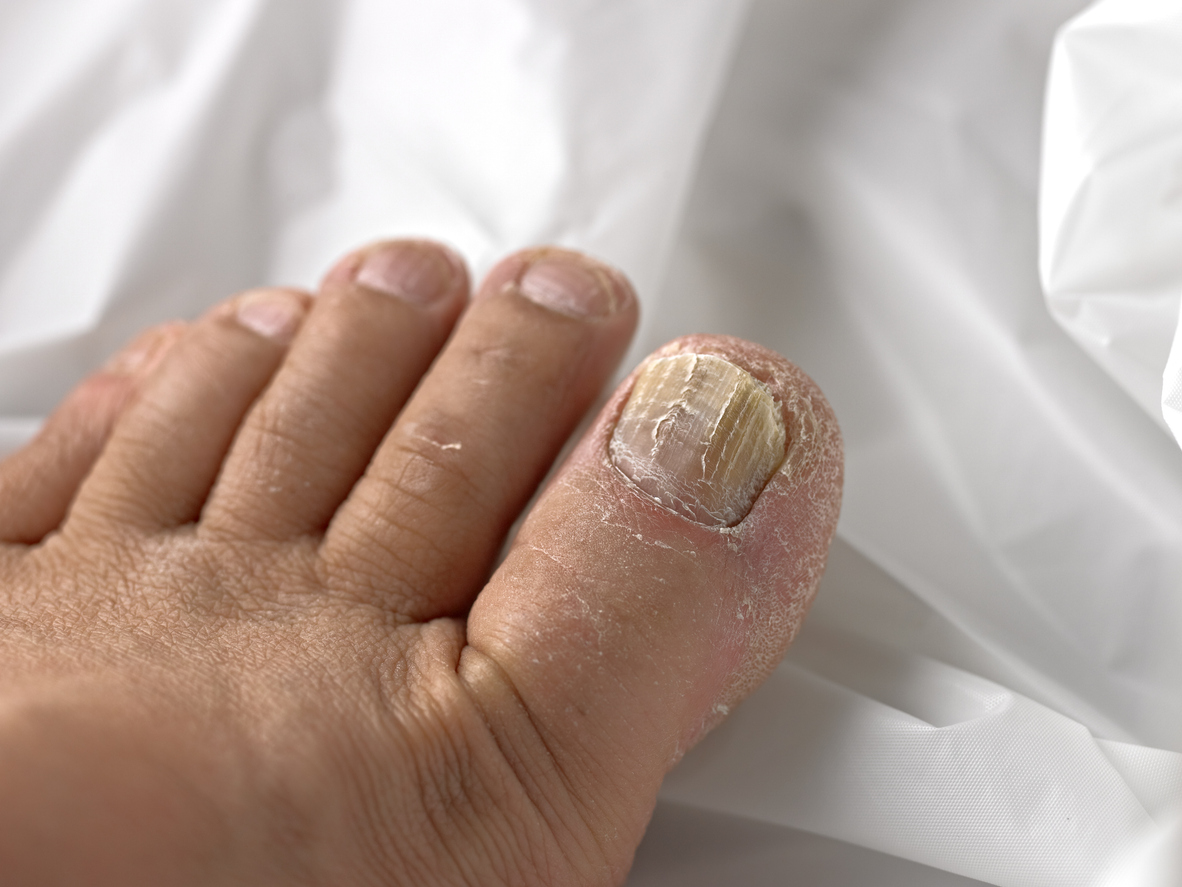 Close-up of a thickened, discolored big toenail with dry surrounding skin, showing signs commonly associated with toenail fungus.