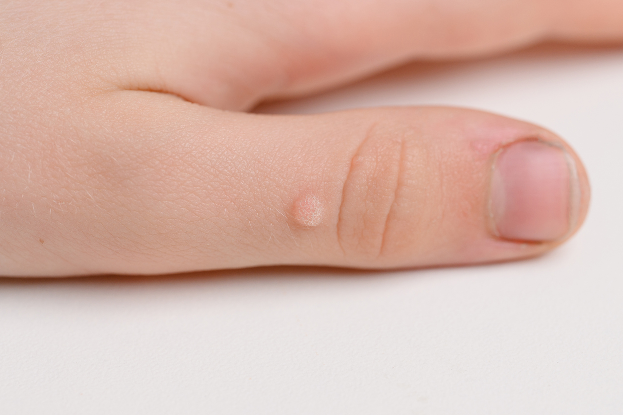 Close-up of a small raised wart on a finger, showing the rough skin texture associated with common warts.