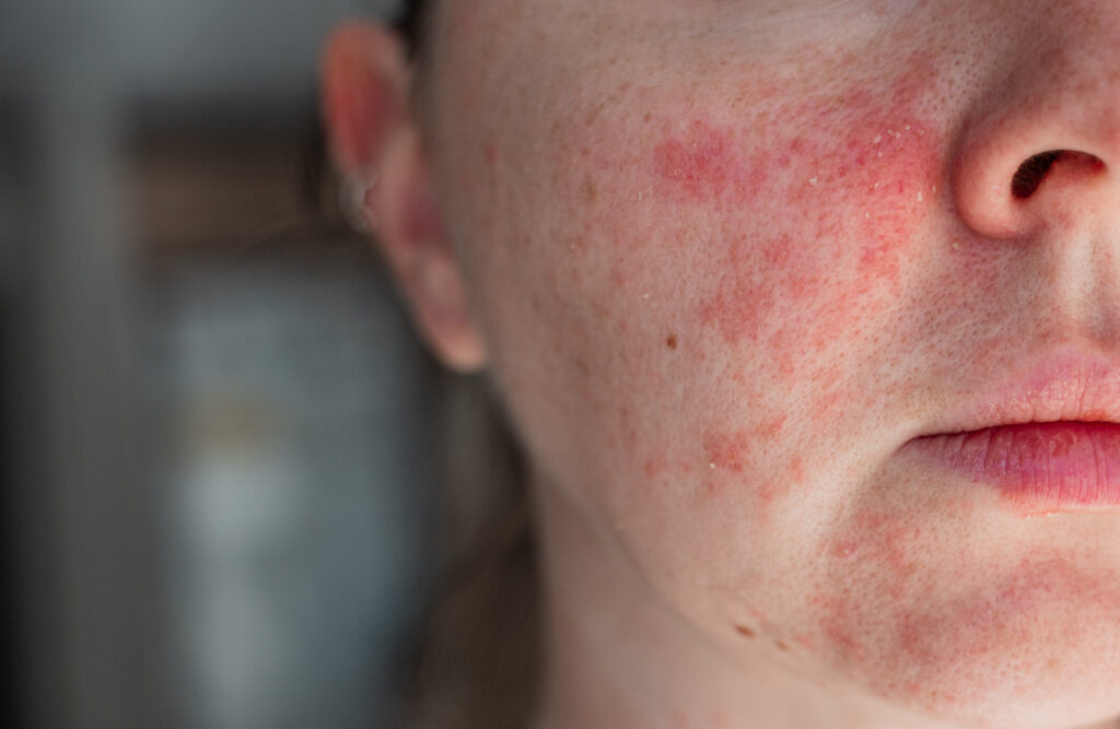 Close-up of facial redness and uneven skin tone with visible red patches across the cheek and around the nose