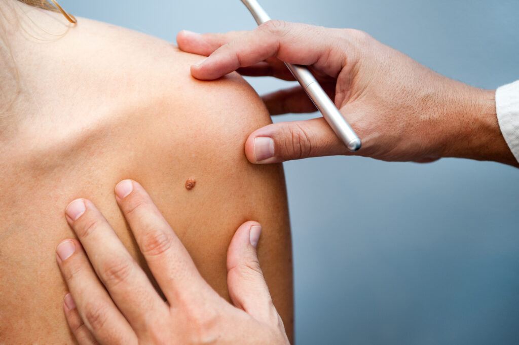 Dermatologist examining a raised mole on a patient’s shoulder during a skin cancer screening.