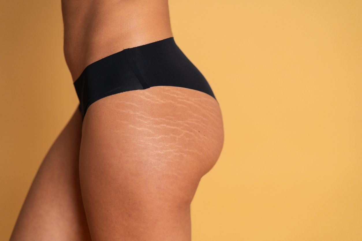 Close-up of white stretch marks on the hip and upper thigh.